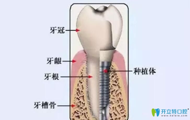 種植牙植骨疼嗎