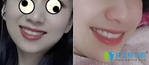 在廣州華美戴隱適美牙套第8個(gè)月效果 在廣州華美戴隱適美牙套第8個(gè)月效果