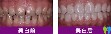 云南華美美萊口腔冷光美白前后對比圖
