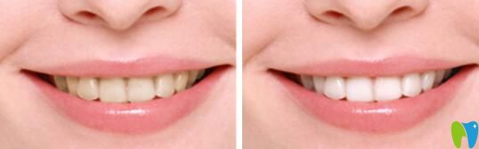 梅州哪家做牙齒美白效果好？愛麗諾牙齒冷光美白效果公布