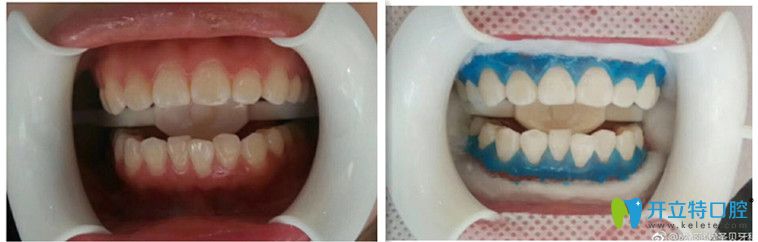 成都圣貝黃祎銘牙齒美白效果圖