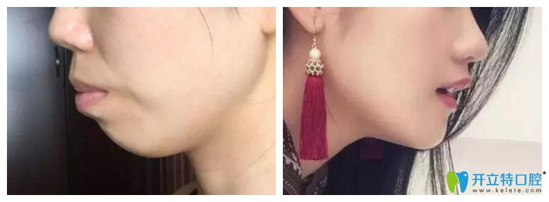 突嘴齙牙矯正前后對(duì)比照