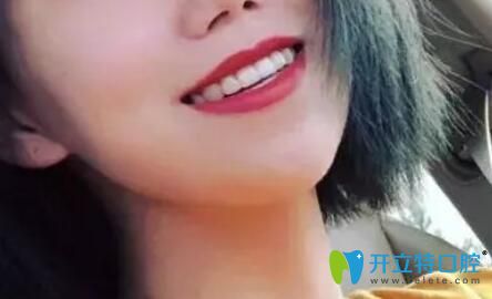 愛麗諾口腔牙齒矯正一年半下牙套效果圖