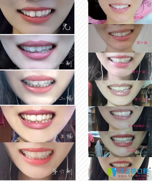 牙齒不齊矯正戴6副隱形牙套的效果