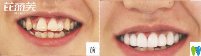金華芘麗芙口腔矯正虎牙前后對(duì)比效果