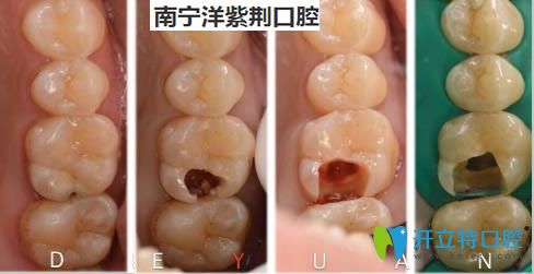 <!--<i data=20240703-sp></i>-->口腔覃琨醫(yī)生根管治療案例對(duì)比圖 <!--<i data=20240703-sp></i>-->口腔覃琨醫(yī)生根管治療案例對(duì)比圖