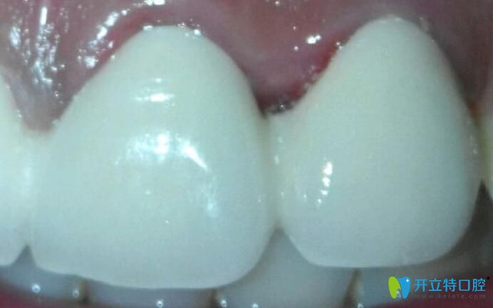 烤瓷牙不密合是什么感覺 烤瓷牙不密合是什么感覺