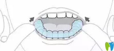 隱適美牙套摘除方法