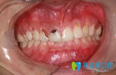 怎么預防可樂牙