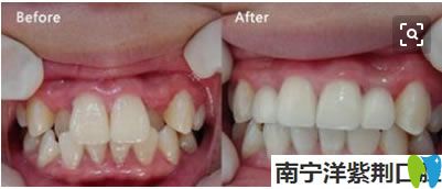 兒童虎牙矯正前后對(duì)比效果 兒童虎牙矯正前后對(duì)比效果