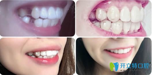 金華芘麗芙齙牙矯正前后對(duì)比照