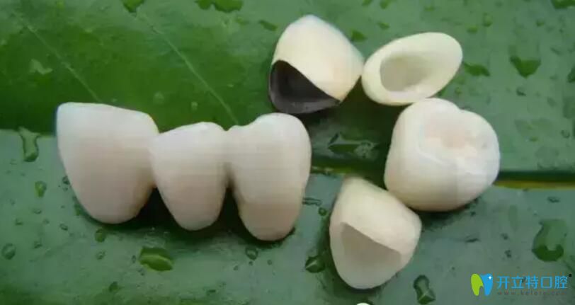 烤瓷牙密合的標準 烤瓷牙密合的標準