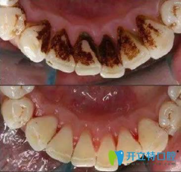 長(zhǎng)春欣雅口腔李國(guó)民醫(yī)生洗牙前后對(duì)比效果