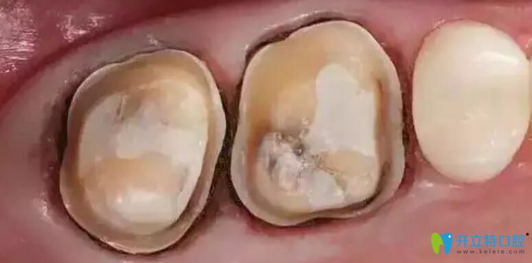 烤瓷牙什么樣算不密合?烤瓷牙不密合什么感覺,該怎么補(bǔ)救?