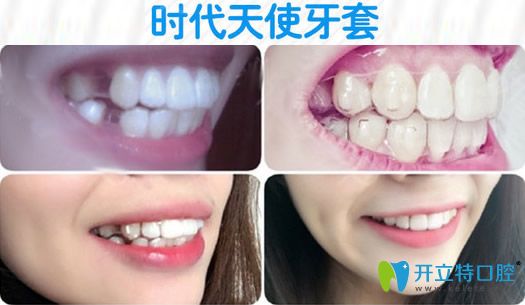 金華芘麗芙成年人時(shí)代天使隱形矯正對比效果