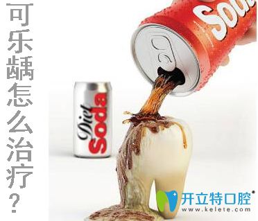 求問可樂齲怎么治療？專業(yè)解答可樂牙的治療費(fèi)用和方法