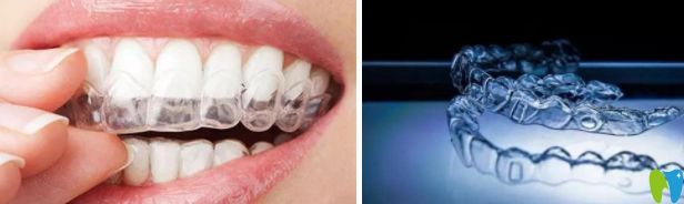 正畸必看摘戴隱形牙套的過程圖解及隱形牙套怎么清潔