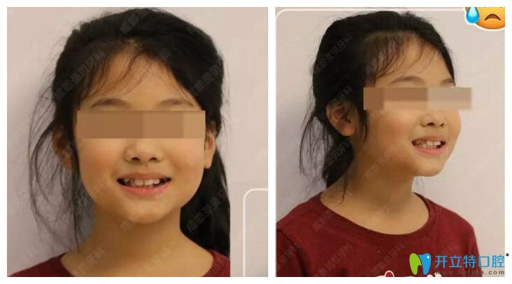 成都圣貝口腔小孩輕微齙牙、個別牙反頜在成都圣貝口腔做正畸案例效果
