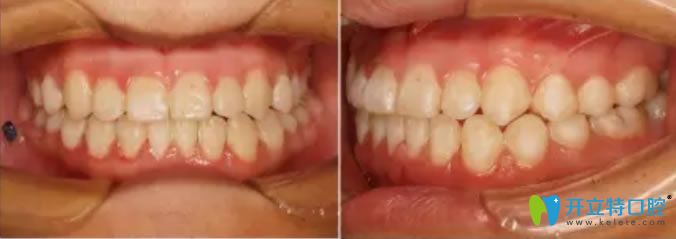 <!--<i data=20240703-sp></i>-->口腔陸千程醫(yī)生安氏Ⅲ類錯(cuò)頜矯正后案例效果圖