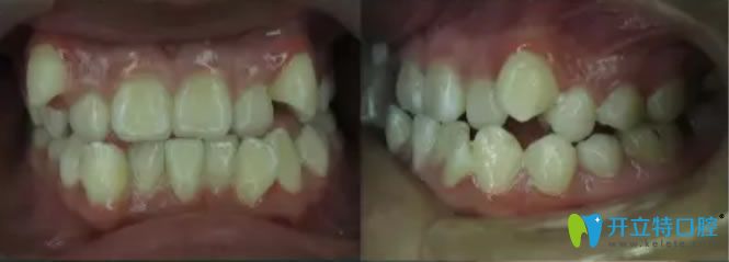 安氏Ⅲ類錯(cuò)頜矯正術(shù)前照