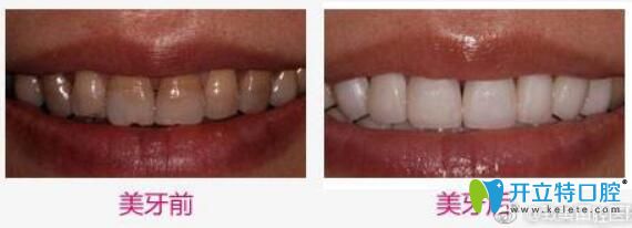 惠州致美口腔好不好？看致美口腔賴健美牙齒冷光美白案例效果對比圖