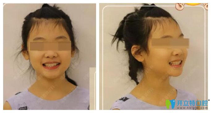 小孩子在成都圣貝口腔矯正后效果圖 小孩子在成都圣貝口腔矯正后效果圖