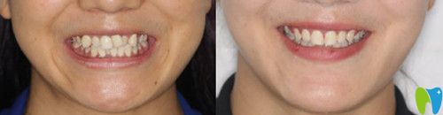 陶瓷自鎖托槽矯正技術(shù)