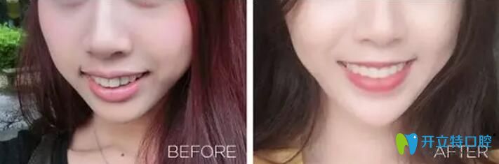 諾得齒科上頜牙槽前突采用隱適美隱形矯正案例公布