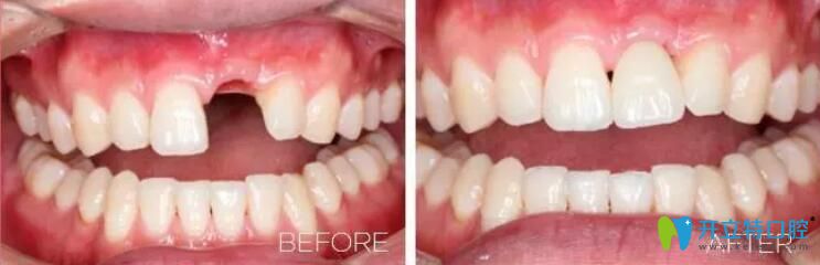 深圳哪家種植牙好？諾德齒科單顆牙種植案例一覽