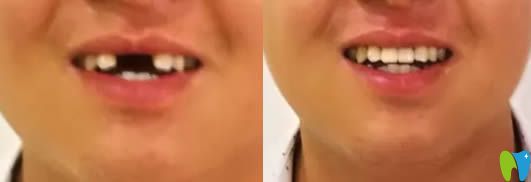 武漢清華陽光口腔即刻種植牙真人案例效果圖