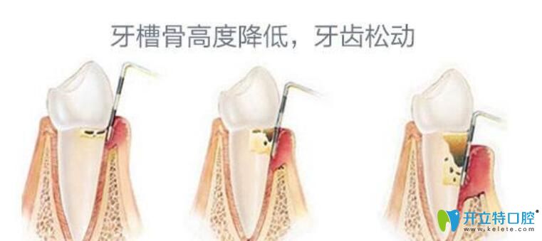 牙齒松動(dòng)是什么原因造成的