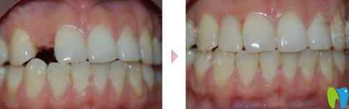 保定合眾口腔種植前后效果圖 保定合眾口腔種植前后效果圖