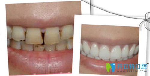 保定合眾口腔修復(fù)前后對(duì)比圖 保定合眾口腔修復(fù)前后對(duì)比圖