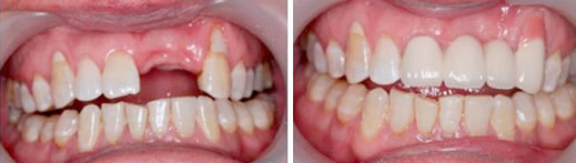 對比活動假牙和種植牙后決定在深圳好佰年口腔做即刻種植