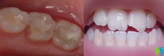 顧客問后牙缺了一小塊怎么辦以及牙齒缺了一塊需要補(bǔ)牙嗎?