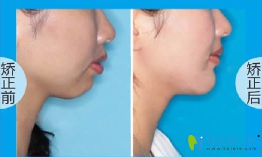 拜博口腔成人齙牙矯正前后對比效果及臉型變化