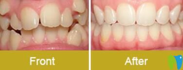 深圳諾得齒科牙齒矯正案例