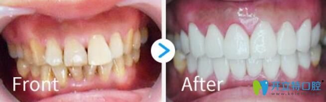 柯明瓷貼面修復四環(huán)素牙案例