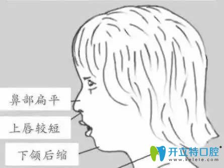 小孩經常用嘴巴呼吸會導致臉型變丑,教你如何糾正口呼吸