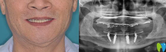 林大爺在佛山智媄口腔做全口種植牙后照片