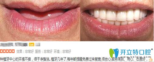 佛山智媄口腔全口種植牙案例 佛山智媄口腔全口種植牙案例