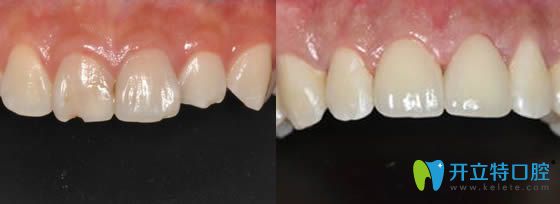 無錫北極星口腔姚凱牙體修復(fù)效果對(duì)比圖 無錫北極星口腔姚凱牙體修復(fù)效果對(duì)比圖