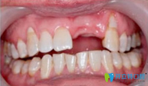 口腔種植前的牙齒