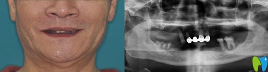 68歲老人在佛山智媄口腔做all-on-4全口種植牙重新圓了美食夢(mèng)