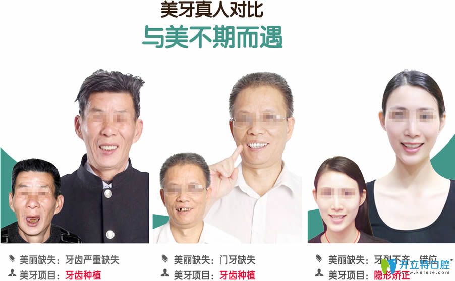 無錫北極星口腔種植牙真人效果對比圖 無錫北極星口腔種植牙真人效果對比圖