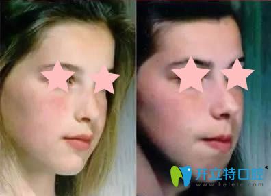 小孩口呼吸造成的面部威海圖