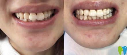 沈陽(yáng)瓷貼面多少錢一顆?在康貝佳口腔做的牙貼面3千元顆貴嗎