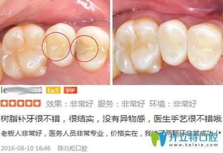 長春陳北松口腔補牙案例