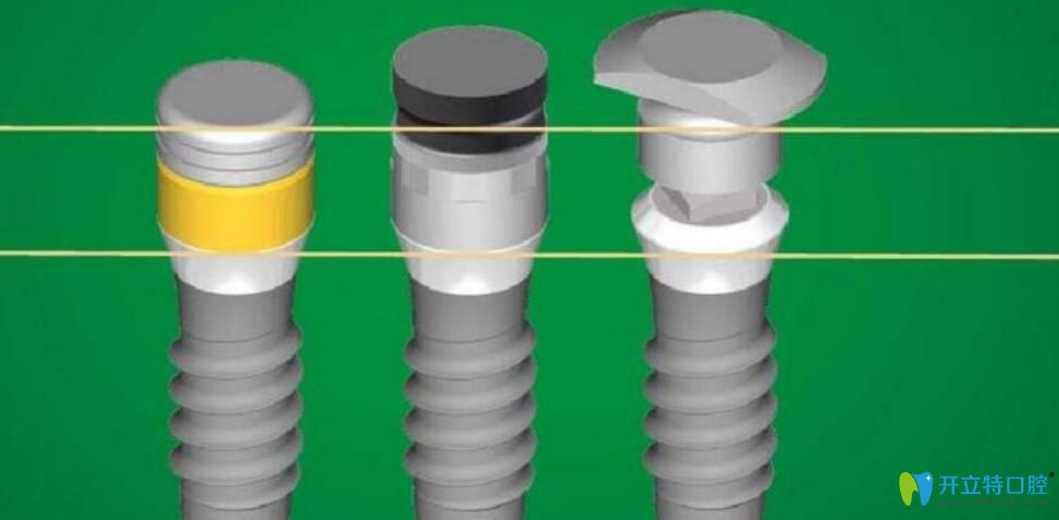 瑞士iti種植體好嗎