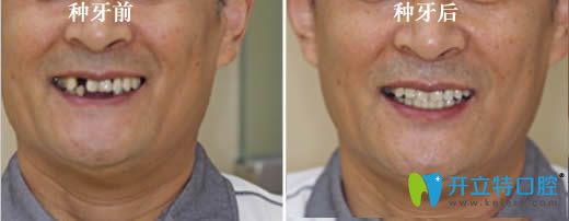 60歲老人半口種植牙前后對比案例
